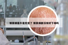 银屑病是不是完蛋了 银屑病都没有好下场吗
