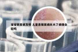 宝宝银屑病发根 儿童患银屑病长大了病情会轻吗