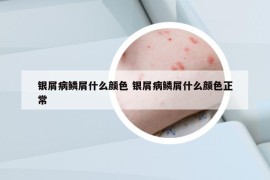 银屑病鳞屑什么颜色 银屑病鳞屑什么颜色正常