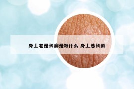 身上老是长癣是缺什么 身上总长藓