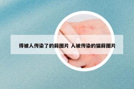 得被人传染了的藓图片 人被传染的猫藓图片