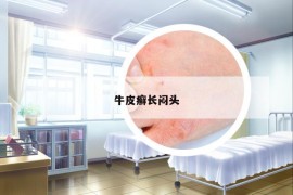 牛皮癣长闷头