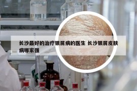 长沙最好的治疗银屑病的医生 长沙银屑皮肤病哪家强