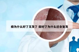 癣为什么好了又发了 藓好了为什么还会复发