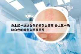 身上起一块块白色的癣怎么回事 身上起一块块白色的癣怎么回事图片