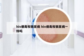 hiv病毒和银屑病 hiv病毒和银屑病一样吗