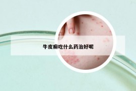 牛皮癣吃什么药治好呢