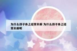 为什么孩子身上经常长癣 为什么孩子身上经常长癣呢