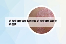 济南看银屑病哪家医院好 济南看银屑病最好的医院