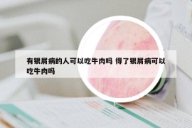 有银屑病的人可以吃牛肉吗 得了银屑病可以吃牛肉吗
