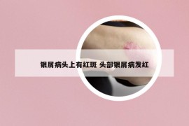 银屑病头上有红斑 头部银屑病发红
