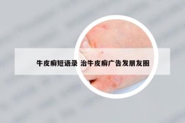 牛皮癣短语录 治牛皮癣广告发朋友圈