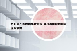 苏州哪个医院除牛皮癣好 苏州看银屑病哪家医院最好