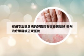 郑州专治银屑病的好医院有哪些医院好 郑州治疗银屑病正规医院