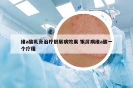 维a酸乳膏治疗银屑病效果 银屑病维a酸一个疗程