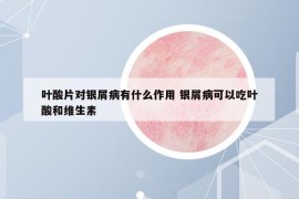 叶酸片对银屑病有什么作用 银屑病可以吃叶酸和维生素