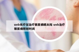 uvb光疗仪治疗银屑病晒太阳 uvb治疗银屑病照射时间