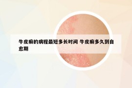 牛皮癣的病程最短多长时间 牛皮癣多久到自愈期