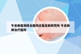牛皮癣是到综合医院还是皮肤研究所 牛皮肤癣治疗医院