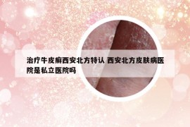 治疗牛皮癣西安北方特认 西安北方皮肤病医院是私立医院吗