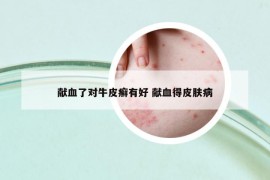 献血了对牛皮癣有好 献血得皮肤病