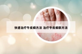 快速治疗牛皮癣方法 治疗牛皮癣新方法