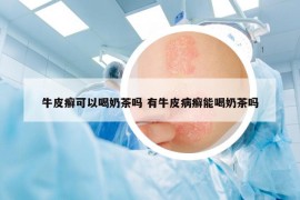 牛皮癣可以喝奶茶吗 有牛皮病癣能喝奶茶吗