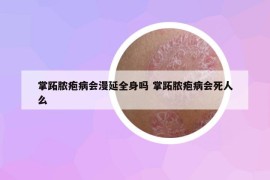 掌跖脓疱病会漫延全身吗 掌跖脓疱病会死人么