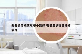 海看银屑病医院哪个最好 看银屑病哪里治疗最好