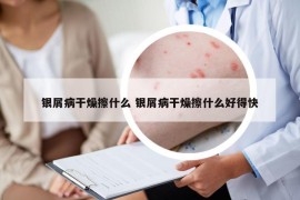 银屑病干燥擦什么 银屑病干燥擦什么好得快