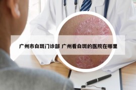 广州市白斑门诊部 广州看白斑的医院在哪里