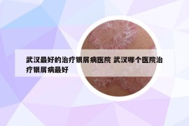 武汉最好的治疗银屑病医院 武汉哪个医院治疗银屑病最好