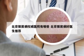 北京银屑病权威医院有哪些 北京银屑病好医生推荐