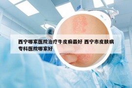 西宁哪家医院治疗牛皮癣最好 西宁市皮肤病专科医院哪家好
