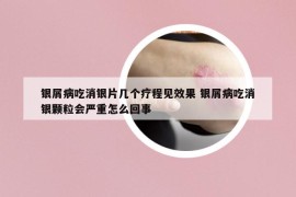 银屑病吃消银片几个疗程见效果 银屑病吃消银颗粒会严重怎么回事
