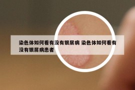 染色体如何看有没有银屑病 染色体如何看有没有银屑病患者
