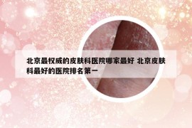 北京最权威的皮肤科医院哪家最好 北京皮肤科最好的医院排名第一