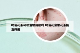 喝菊花茶可以治银屑病吗 喝菊花金银花茶能治痔疮
