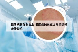 银屑病长在包皮上 银屑病长包皮上能同房吗会传染吗