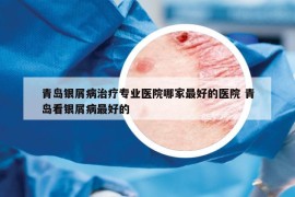 青岛银屑病治疗专业医院哪家最好的医院 青岛看银屑病最好的