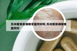 苏州看银屑病哪家医院好吗 苏州银屑病哪里医院好