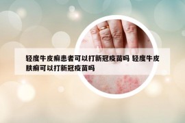 轻度牛皮癣患者可以打新冠疫苗吗 轻度牛皮肤癣可以打新冠疫苗吗