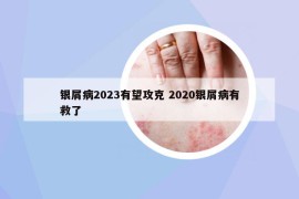 银屑病2023有望攻克 2020银屑病有救了