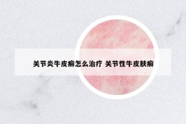 关节炎牛皮癣怎么治疗 关节性牛皮肤癣