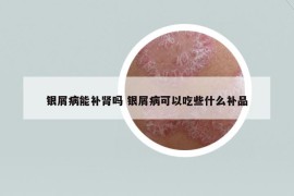 银屑病能补肾吗 银屑病可以吃些什么补品