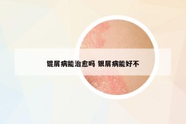 锟屑病能治愈吗 银屑病能好不