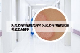 头皮上有白色的皮屑块 头皮上有白色的皮屑块是怎么回事