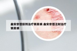 曲安奈德搽剂治疗银屑病 曲安奈德注射治疗银屑病