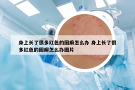 身上长了很多红色的圈癣怎么办 身上长了很多红色的圈癣怎么办图片