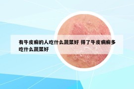 有牛皮癣的人吃什么蔬菜好 得了牛皮病癣多吃什么蔬菜好